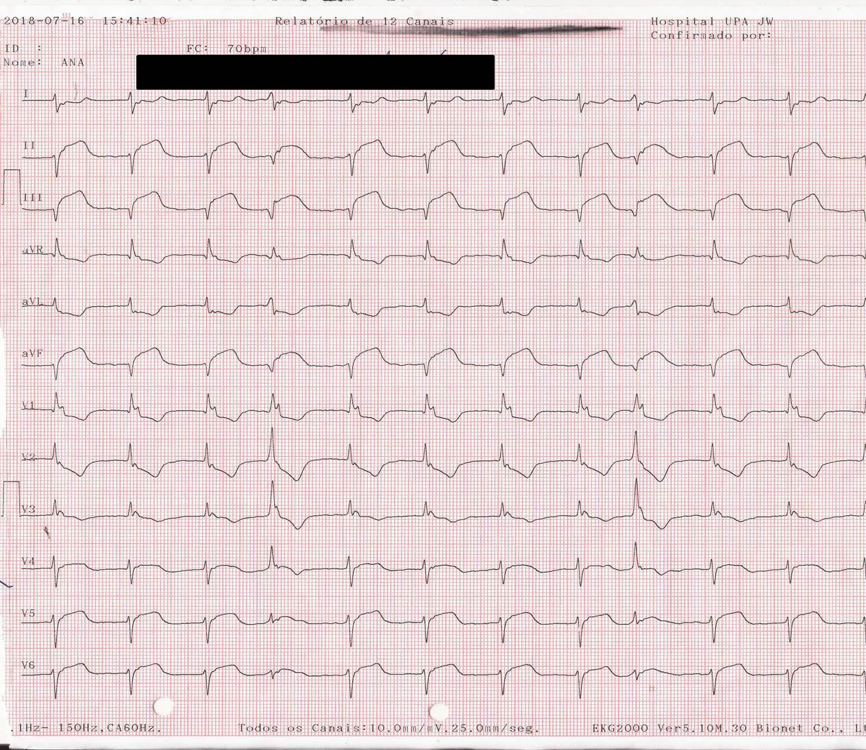 Mujer que durante episodio de angor prolongado presenta FV que es revertida constatándose compromiso de la CD con oclusión de la arteria que irriga el NAV