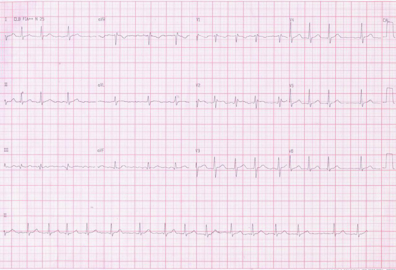 Mujer de 50 años con síndrome de Brugada oculto desenmascarado por propafenona asociado a fibrilación auricular que determina palpitaciones taquicárdicas .