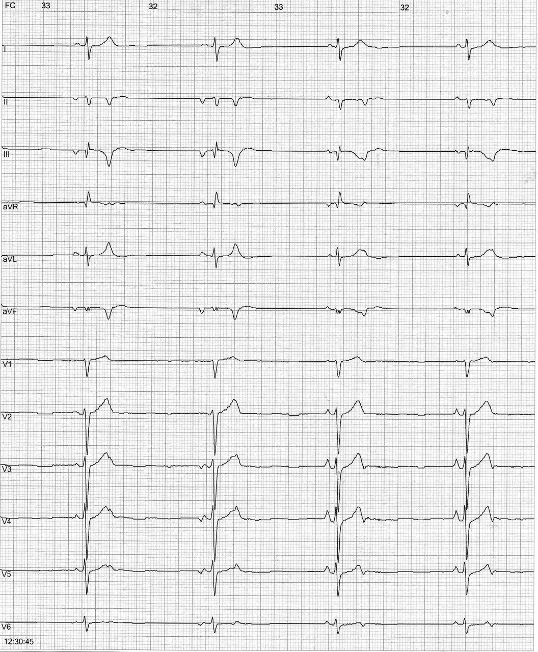 Paciente masculino de 39 años con palpitaciones debidas a extrasístoles auriculares bloqueadas y otras con imagen que alterna entre BCRD y BCRI