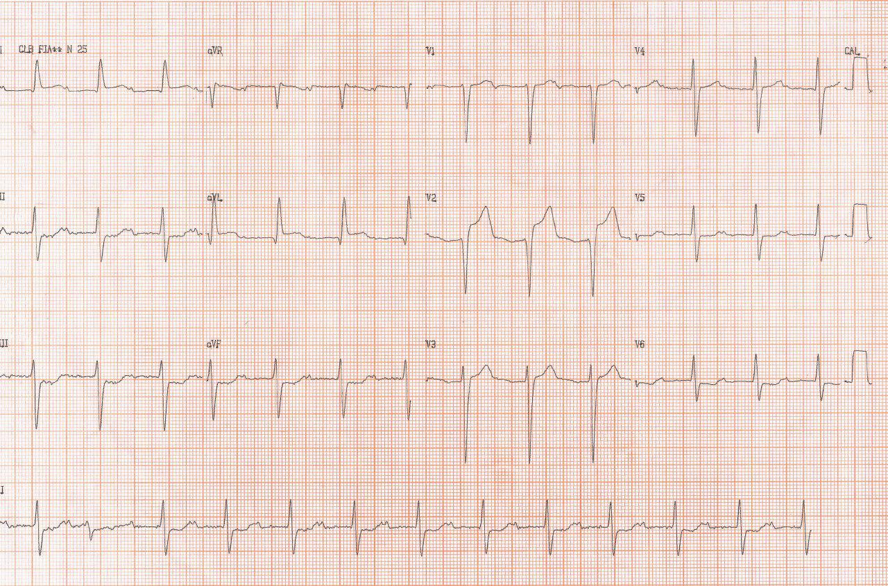 Paciente masculino de 76 años con SCA por lesión de la DA y fracaso de la angioplastia que una semana después presenta bloqueo multisitio