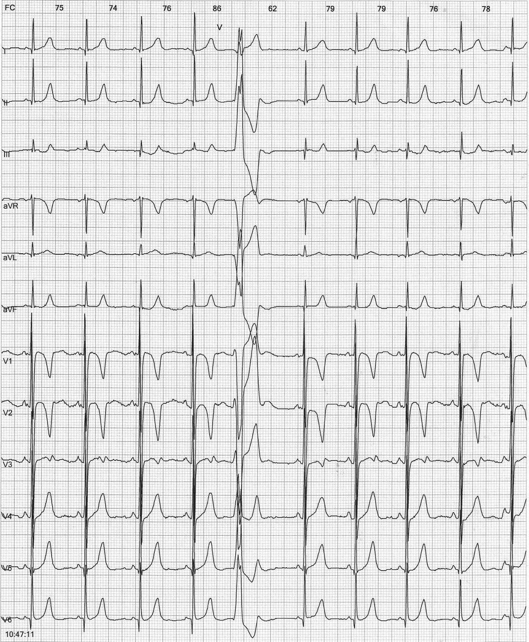 Niño de 5 años con ecocardiograma normal que presenta EVs frecuentes por probable DAVD