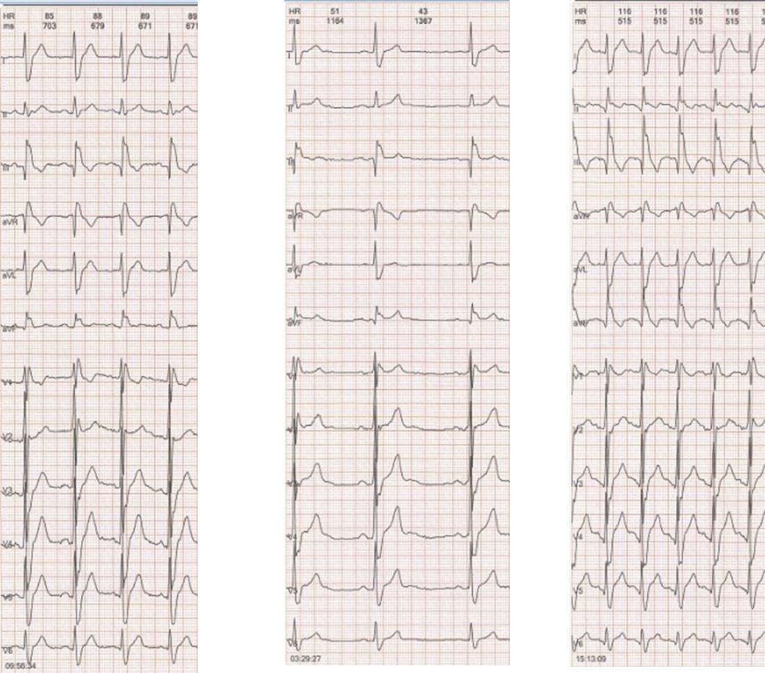 Anciana con BCRD + HbPI durante esfuerzo, que desarrolla episodio sincopal