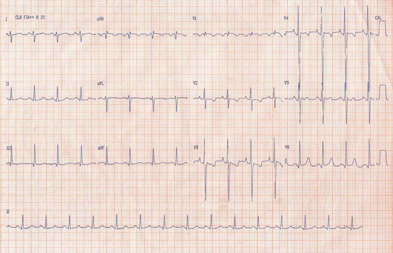 Paciente masculino de 26 años portador de enfermedad mitral reumática con cuadro de insuficiencia cardíaca a quién se practica reempazo mitral con bioprótesis