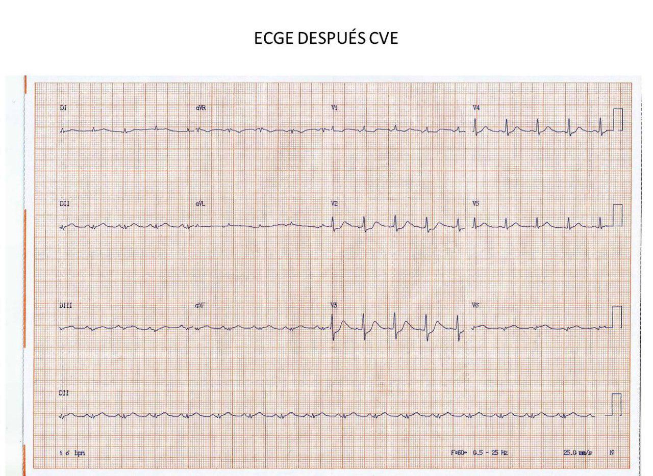 Hombre de 50 años que presenta angor prolongado seguido de FV que es recuperada, por lesión de Cx