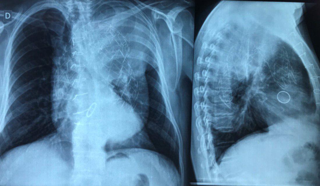Paciente de 47 años, hipertenso, con antecedente de cirugía de Bental por aneurisma de aorta ascendente que presenta disección con ruptura del saco aneurismático y posterior colocación de nueva endoprótesis