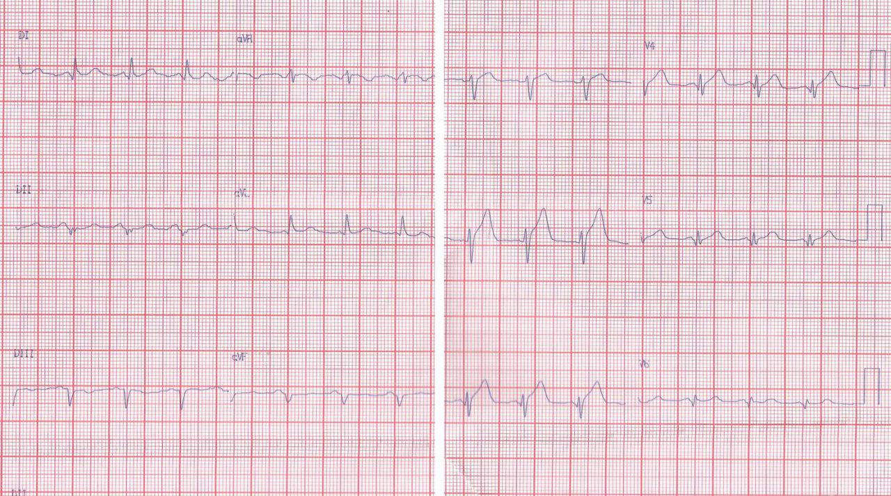 Paciente de 51 años con angor prolongado y presencia de isquemia grado 1 en el ECG debido a lesión de DA proximal