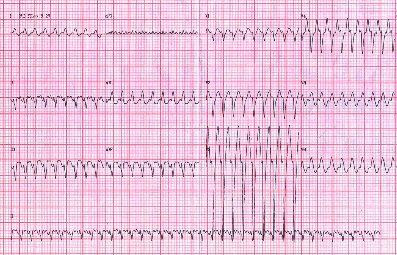 Hombre de 49 años con palpitaciones por presencia de un aleteo auricular 1:1 que luego pasa a 3:1