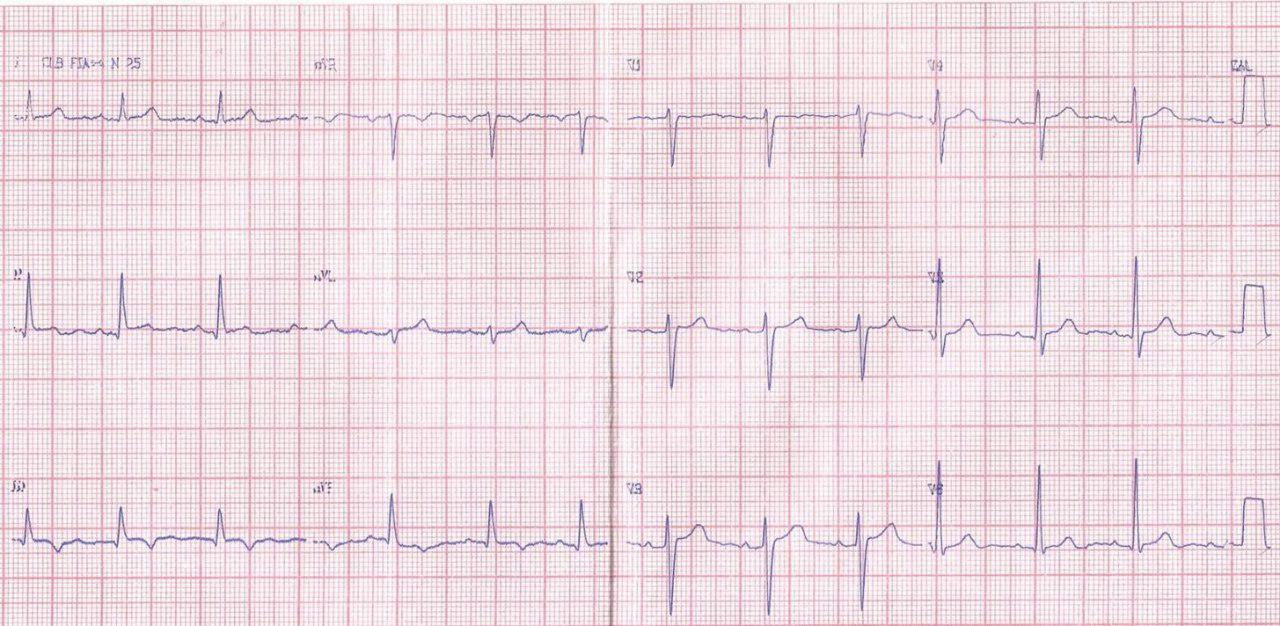 Joven mujer de 18 años que presenta episodios sincopales precedidos de palpitaciones, con antecedentes de MS familiar y presencia de síndrome de repolarización precoz maligno