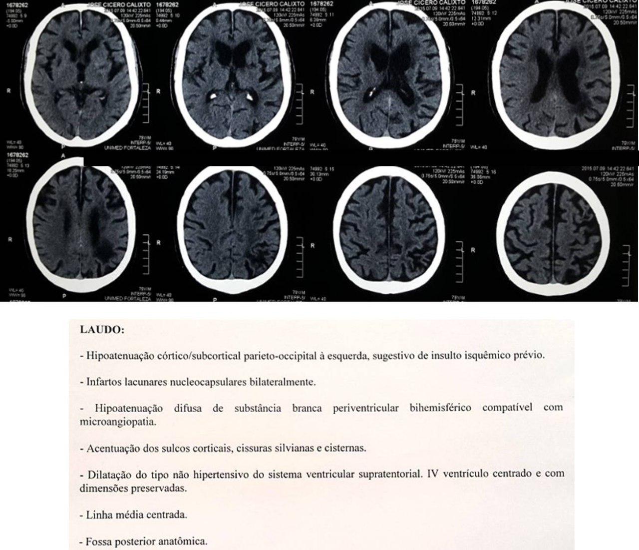 Paciente de 81 años portador de síndrome de Bayés que presenta deterioro cognitivo debido a múltiples episodios  micreoembólicos con infartos lacunares en cerebro