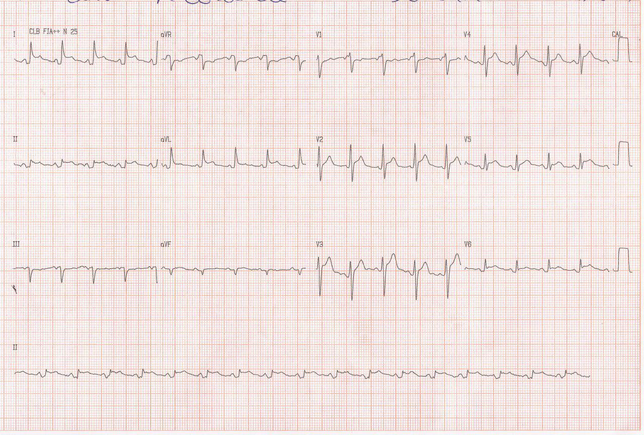 Hombre de 56 años con dolor pleurítico y fiebre debida a pericarditis aguda que presenta aleteo auricular que no responde al MSC