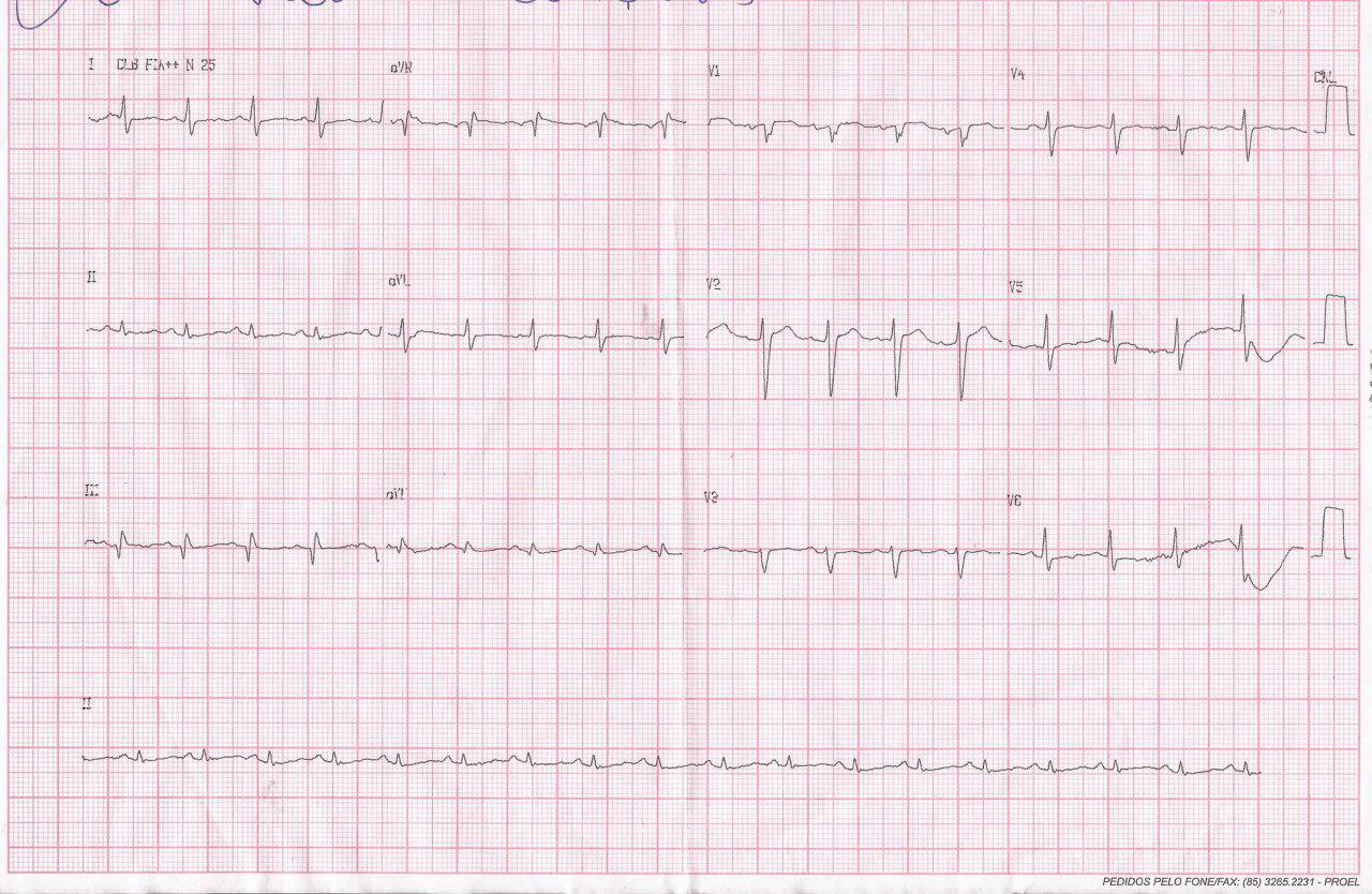 Paciente que presenta episodio sincopal en el que se constata patrón S1Q3T3 por presentar TEP masivo bilateral con arterias coronarias normales y evolución al óbito