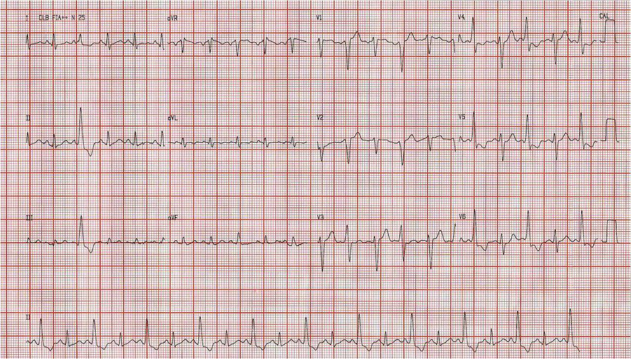 Paciente masculino de 47 años con precordialgia atípica que presenta arritmia bigeminada cuyo origen es discutido