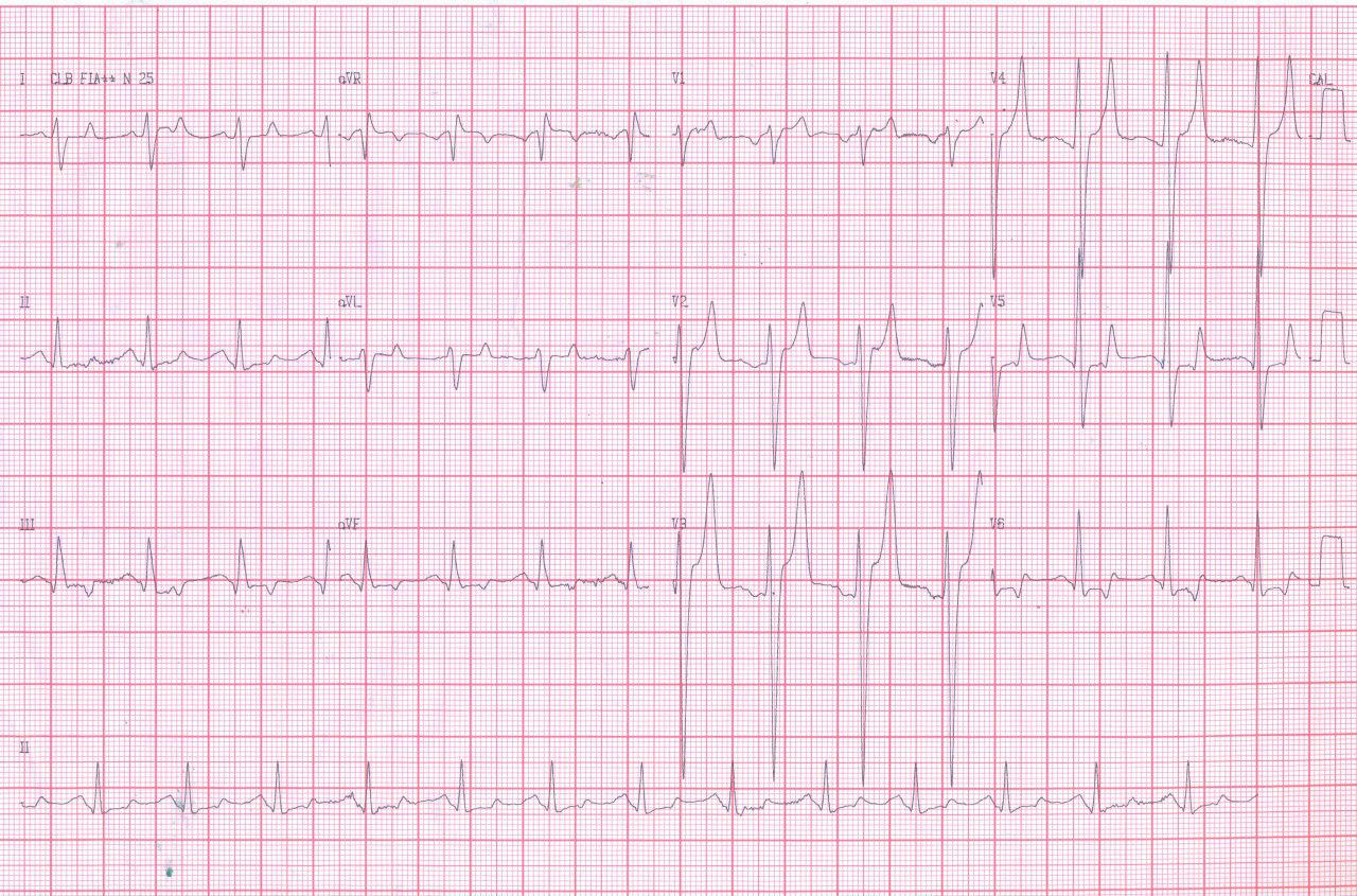 Paciente de 48 años, hipertenso, diabético y renal crónico con severa hiperkalemia que presenta angor prolongado y EAP hipertensivo