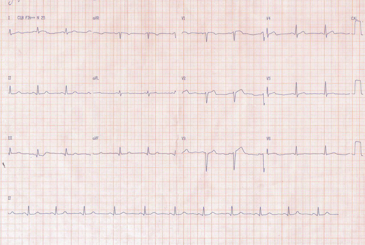 Mujer de 37 años con FR que cursa con SCA cuya CCG muestra severas y difusas lesiones coronarias