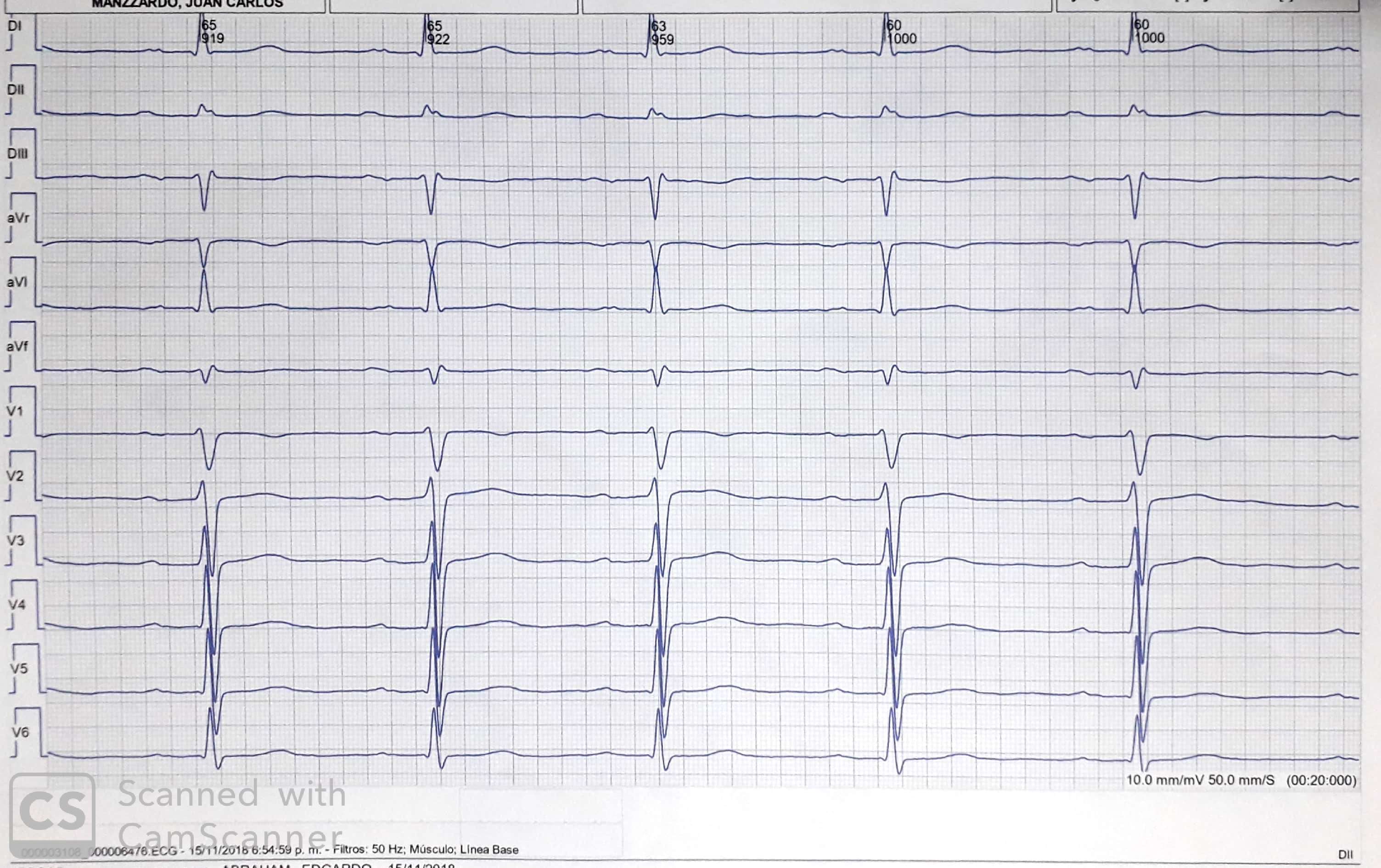 Bloqueo interauricular avanzado (BIA-A) atípico tipo I