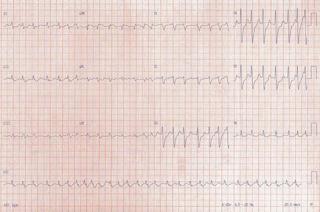 Mujer de 67 años que a posteriori de CRM con puente de safena presenta FA que degenera en FV de la que es recuperada constatándose trombosis del by pass