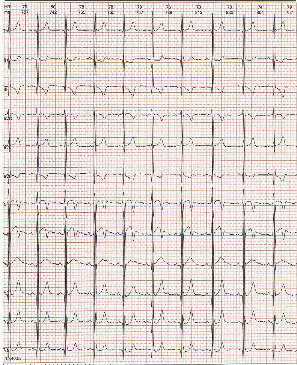 Paciente masculino de 27 años con palpitaciones y dolor precordial no anginoso que presenta vía anómala pósterolateral izquierda intermitente y Ondas T de memoria cardíaca