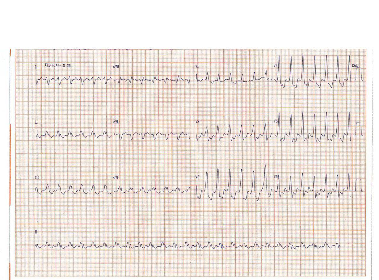 Paciente de 75 años portador de CDI que presenta TV con latidos que presentan pseudo onda delta y manifiesta presentar «choques inapropiados»