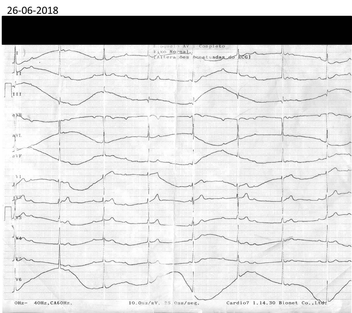 Mujer de 34 años, hipertensa medicada con alfametildopa, con embarazo de 30 semanas, que presentó dos episodios sincopales por BAV atribuido a la medicación