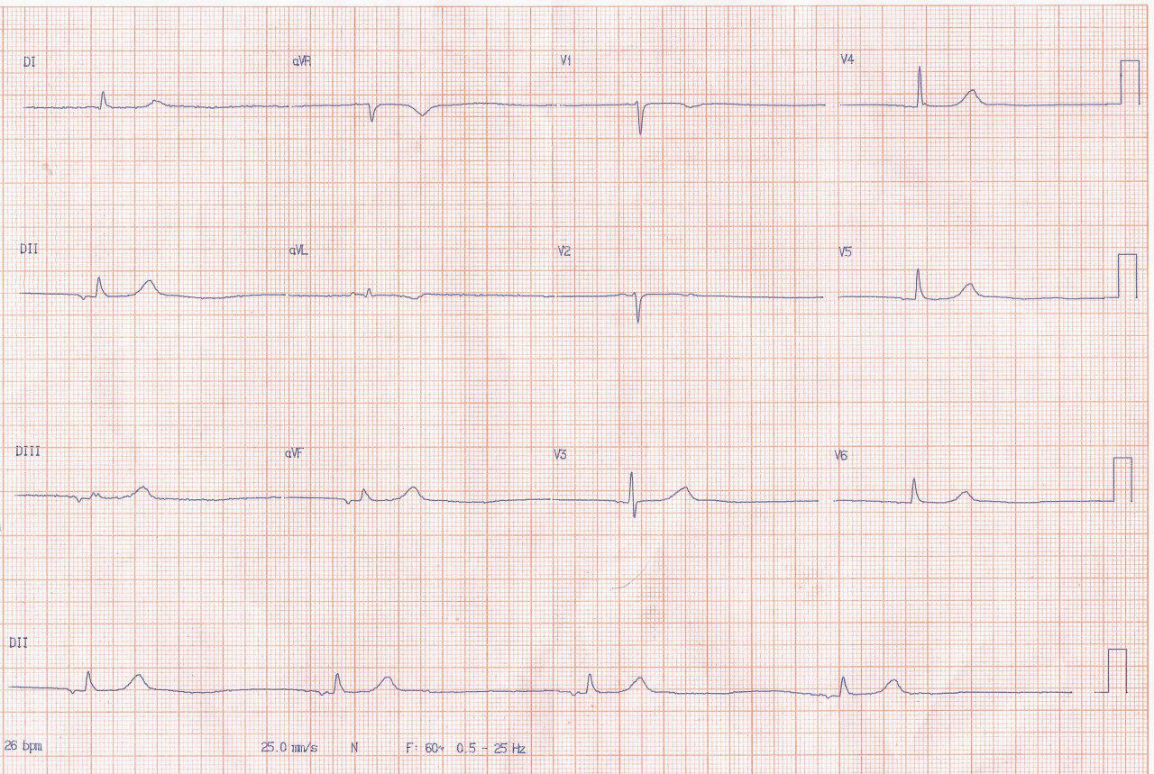 Mujer de 82 años hipotiroidea, con IRC no dialítica medicada con alfametildopa a la que se implanta MP transitorio