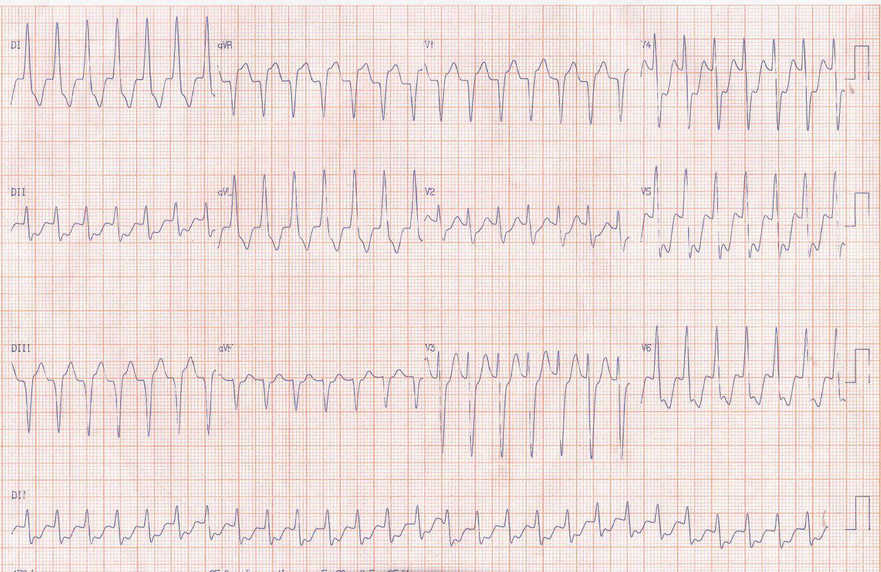 Paciente de 82 años que presenta palpitaciones por reiterados episodios de aleteo auricular que ceden con adenosina y que presenta obstrucción de DA del 80%