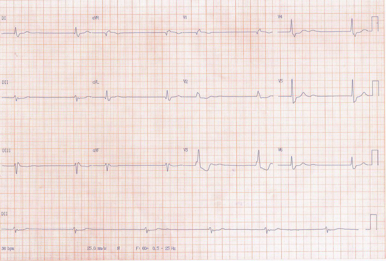 Paciente masculino de 57 años con cuadro de insuficiencia cardíaca presenta episodio sincopal por TV rama a rama que es inducida en EEF y que es tratada con ablación de la rama derecha