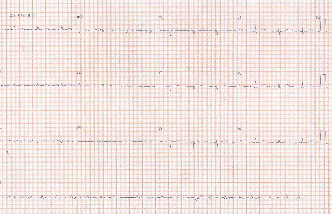 Mujer de 77 años con disnea progresiva que padece de neoplasia de esófago tratada con quimioterapia y radioterapia que presenta hemopericardio por metástasis