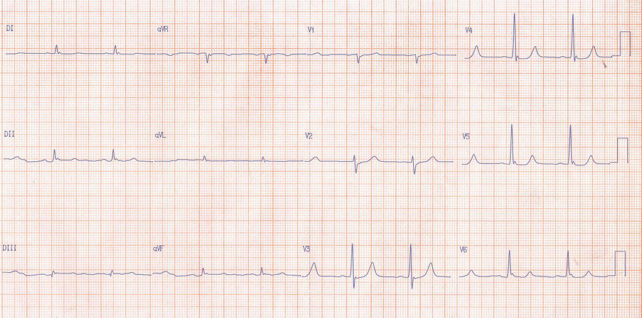 Hombre de 35 años que es recuperado de paro cardíaco extrahospitalario en el que se constata patrón de repolarización precoz maligno que fallece y en el que la autopsia revela hemorragia cerebral