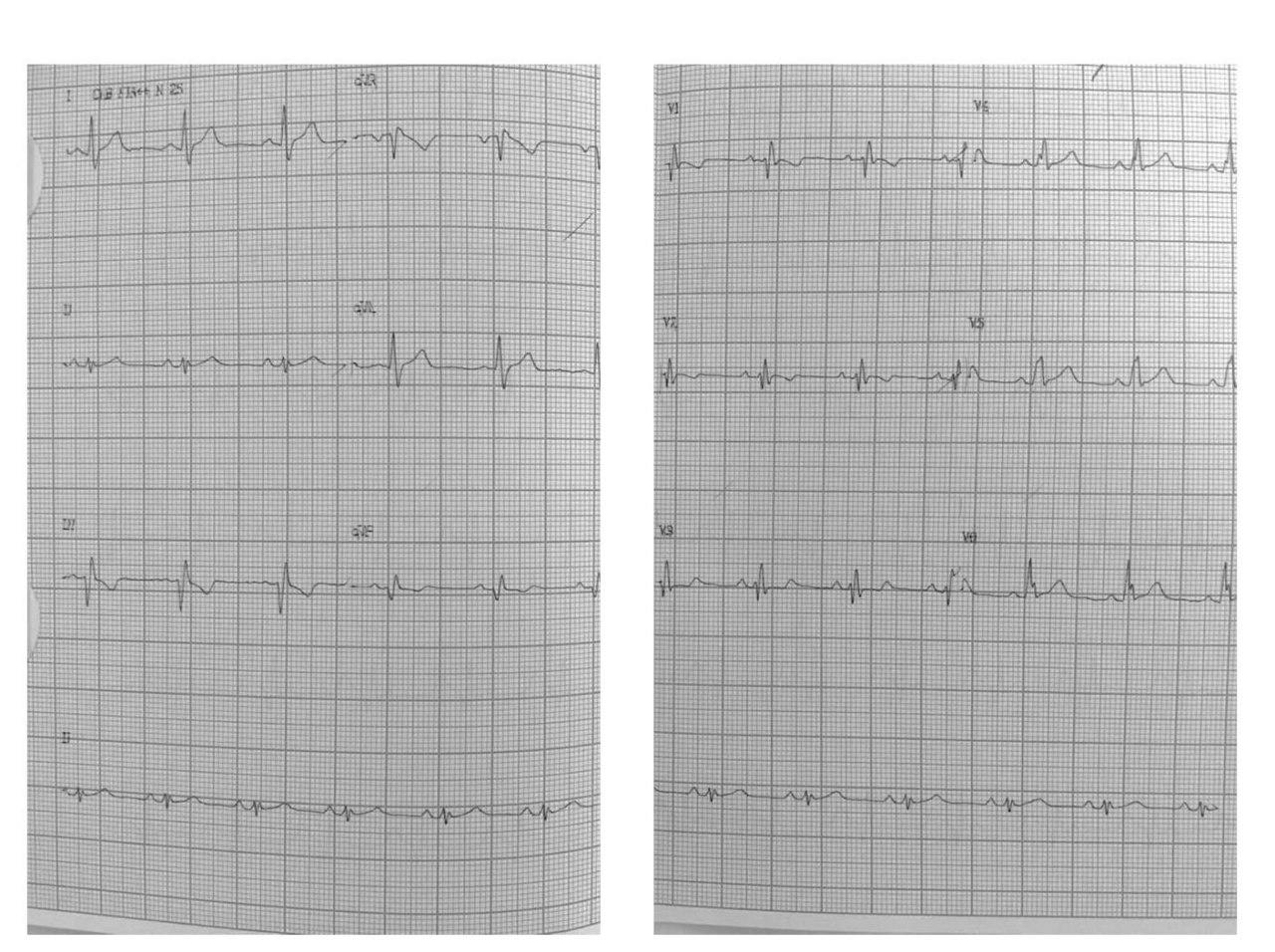 Paciente masculino de 32 años con palpitaciones paroxísticas portador de anomalía de Ebstein