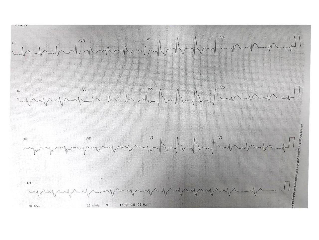 Hombre de 32 años fumador y usuario de cocaína que presenta angor prolongado por compromiso de DA proximal con presencia de trombo y fracaso de angioplastia primaria y aspiración