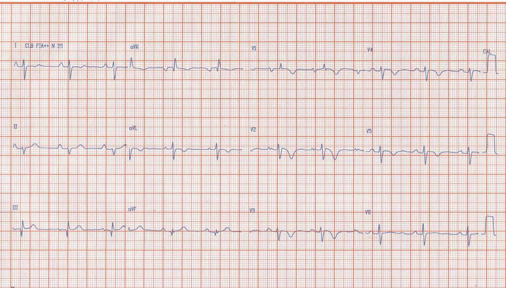 Paciente masculino de 35 años portador de CDI por padecer displasia arritmogénica de ventrículo derecho