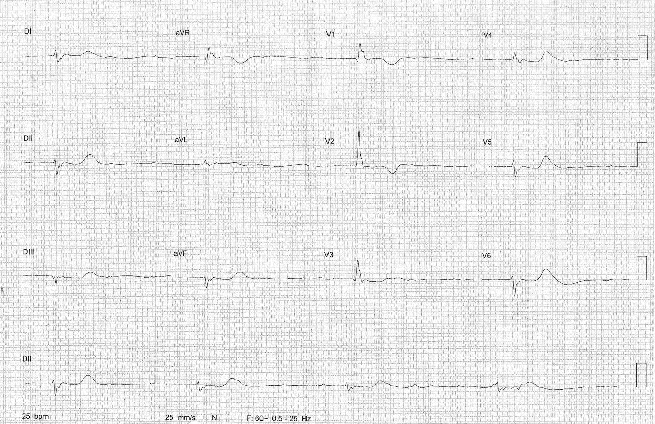 Mujer de 81 años con síndrome de Tako Tsubo y BAVC