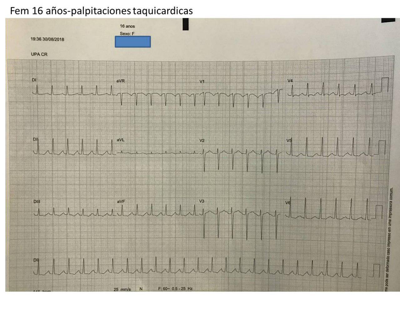 Puérpera de 16 años con palpitaciones por presentar TPSV a 150 lpm que cede con adenosina