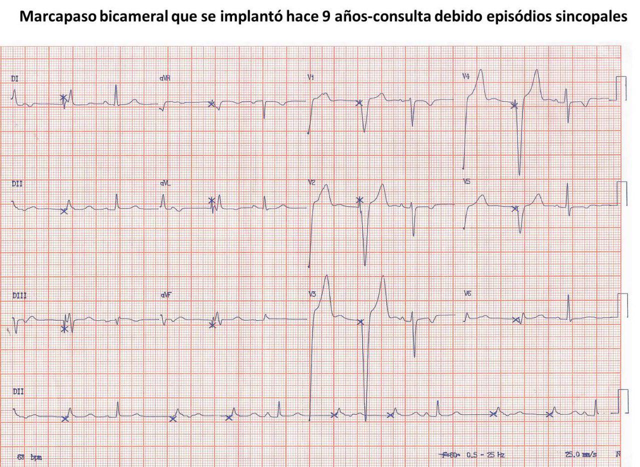 Paciente con MP bicameral implantado hace 9 años que presenta síncopes cuyo ECG muestra estimulación VVI por posible agotamiento y ondas T de memoria cardíaca