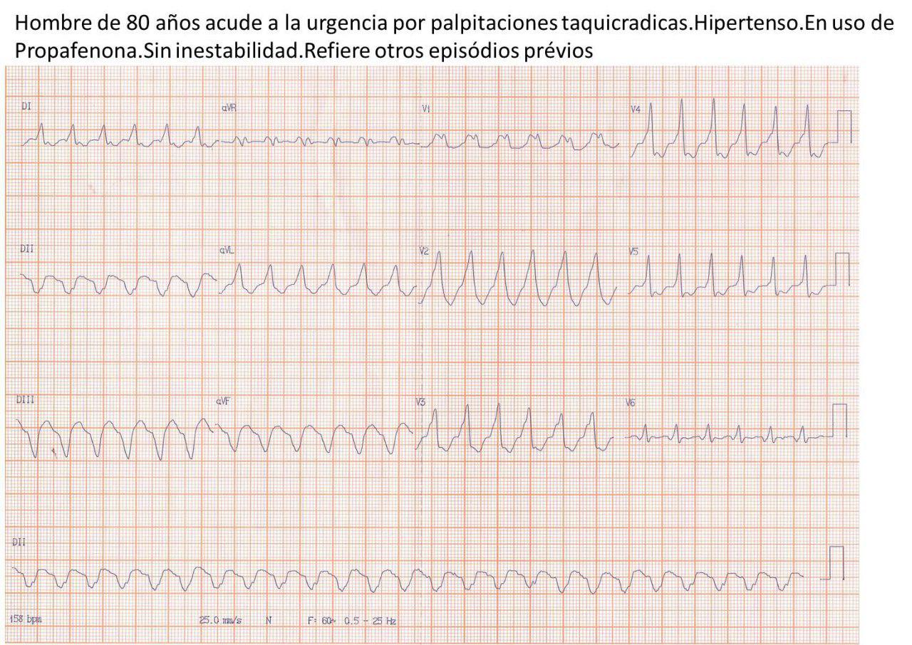 Hombre de 80 años con palpitaciones por presencia de TRAVO por vía pósterolateral izquierda que no cede con adenosina y sí con CVE