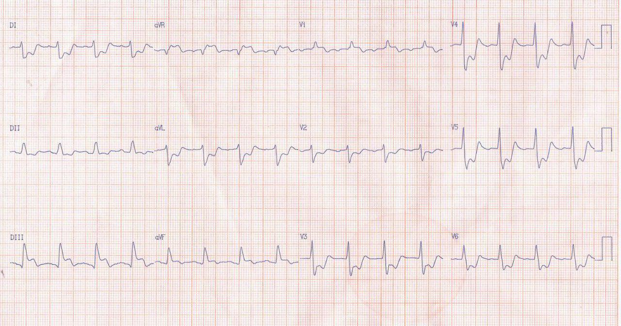 Paciente masculino de 66 años con angor prolongado y EAP por lesión de tres vasos y TCI