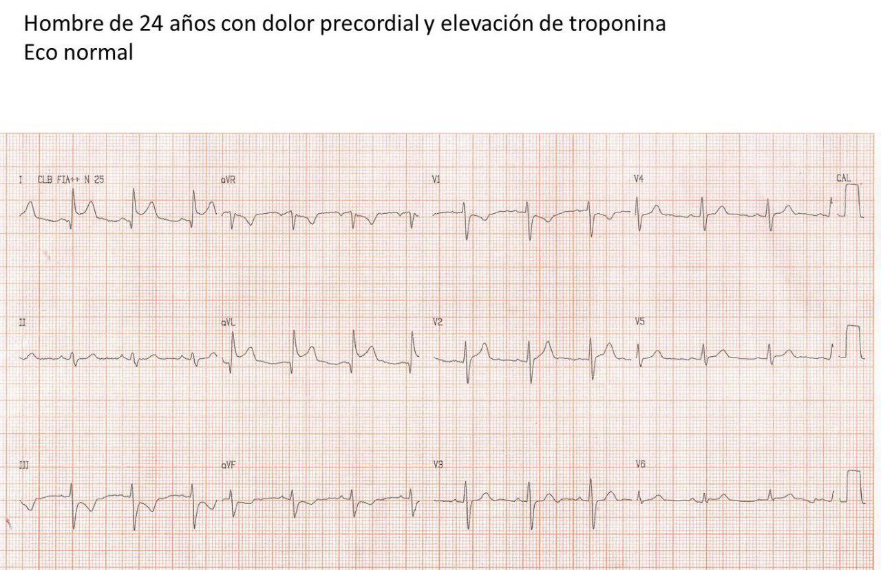 Joven varón de 24 años con dolor precordial y elevación de troponina con coronarias normales por miocarditis aguda