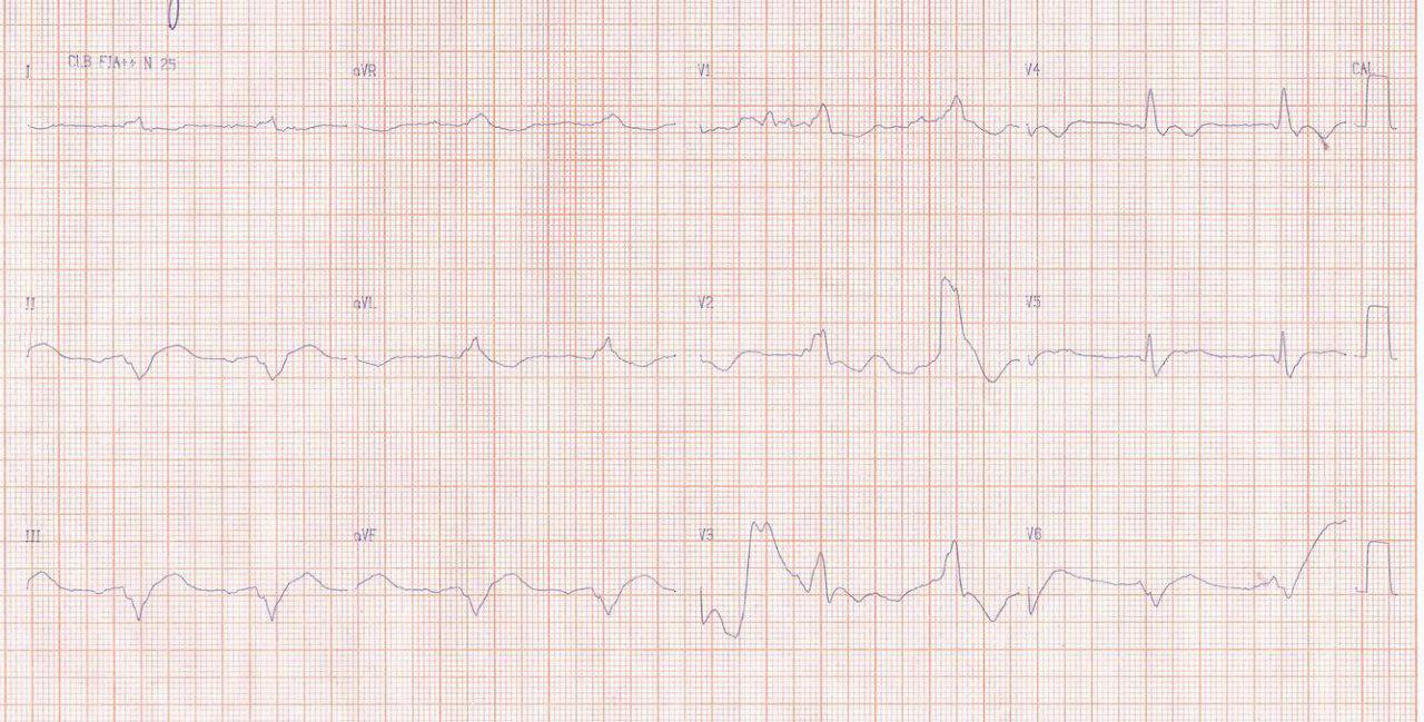 Hombre de 49 años portador de miocardiopatía chagásica crónica con CDI que presenta reiterados episodios de tormenta eléctrica y fallece