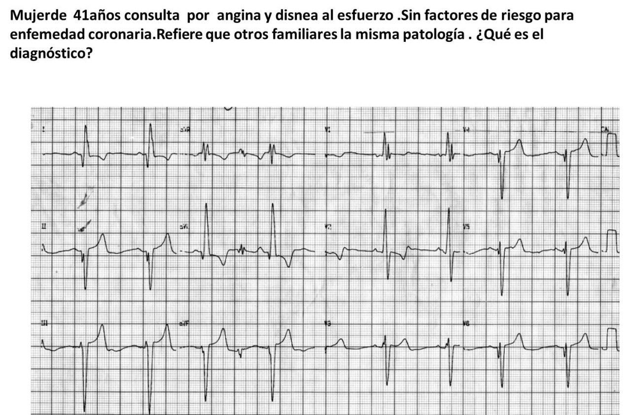 Mujer de 41 años con angor y disnea de esfuerzo portadora de Enfermedad de Fabbry