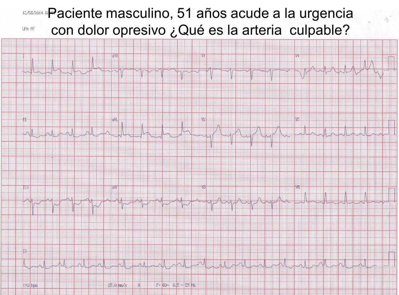 Paciente de 51 años con angor prolongado por IAM de pared media anterior por lesión de arteria 1ª diagonal