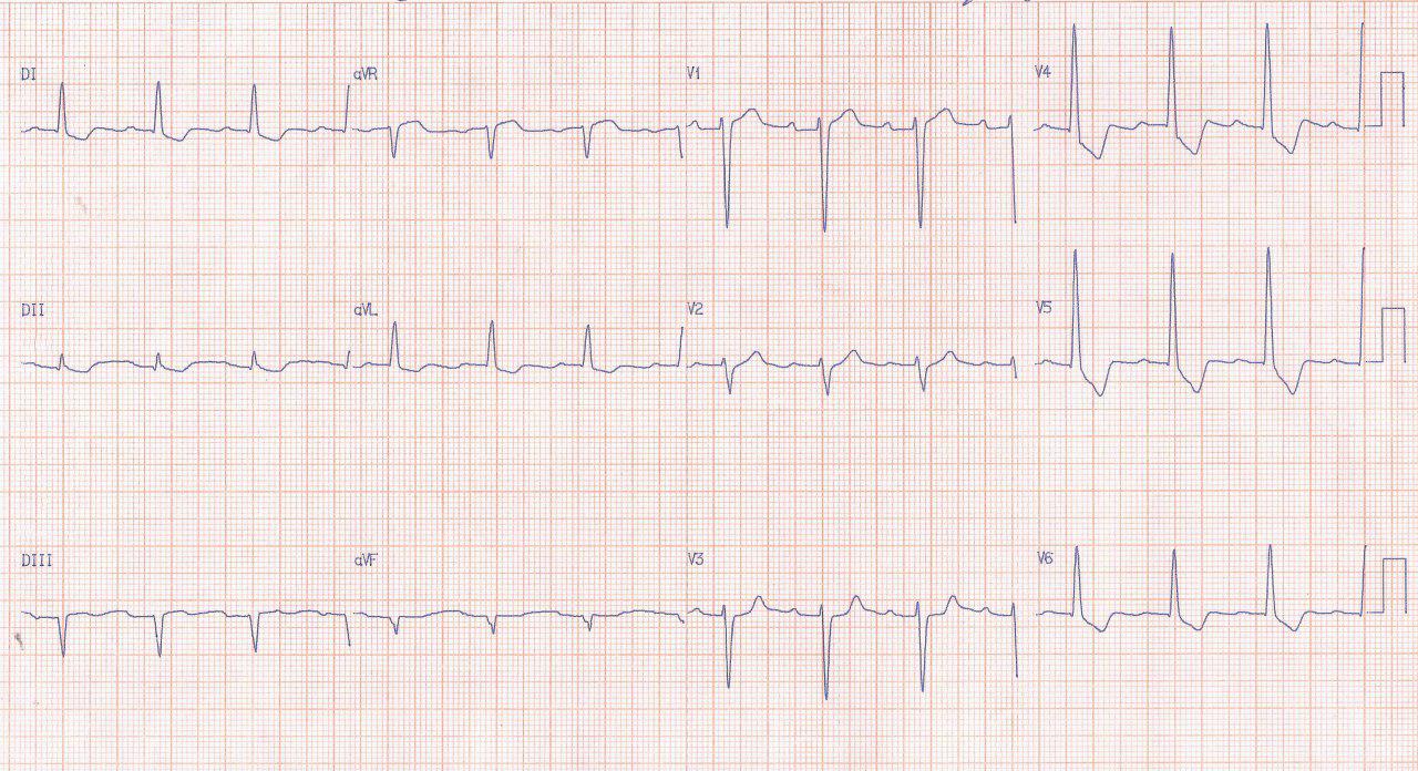 Hombre de 54 años con IRC dialítica que presenta dolor precordial intenso por pseudoisquemia circunsferencial, con arterias coronarias normales