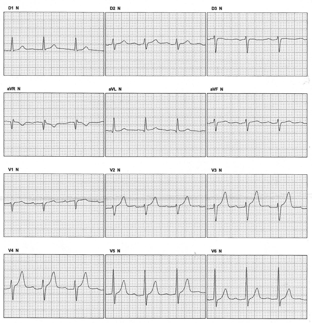 Hombre que 6 meses después de ablación de FA muestra en el ECG signos premonitorios de recurrencia, que acontece a posteriori