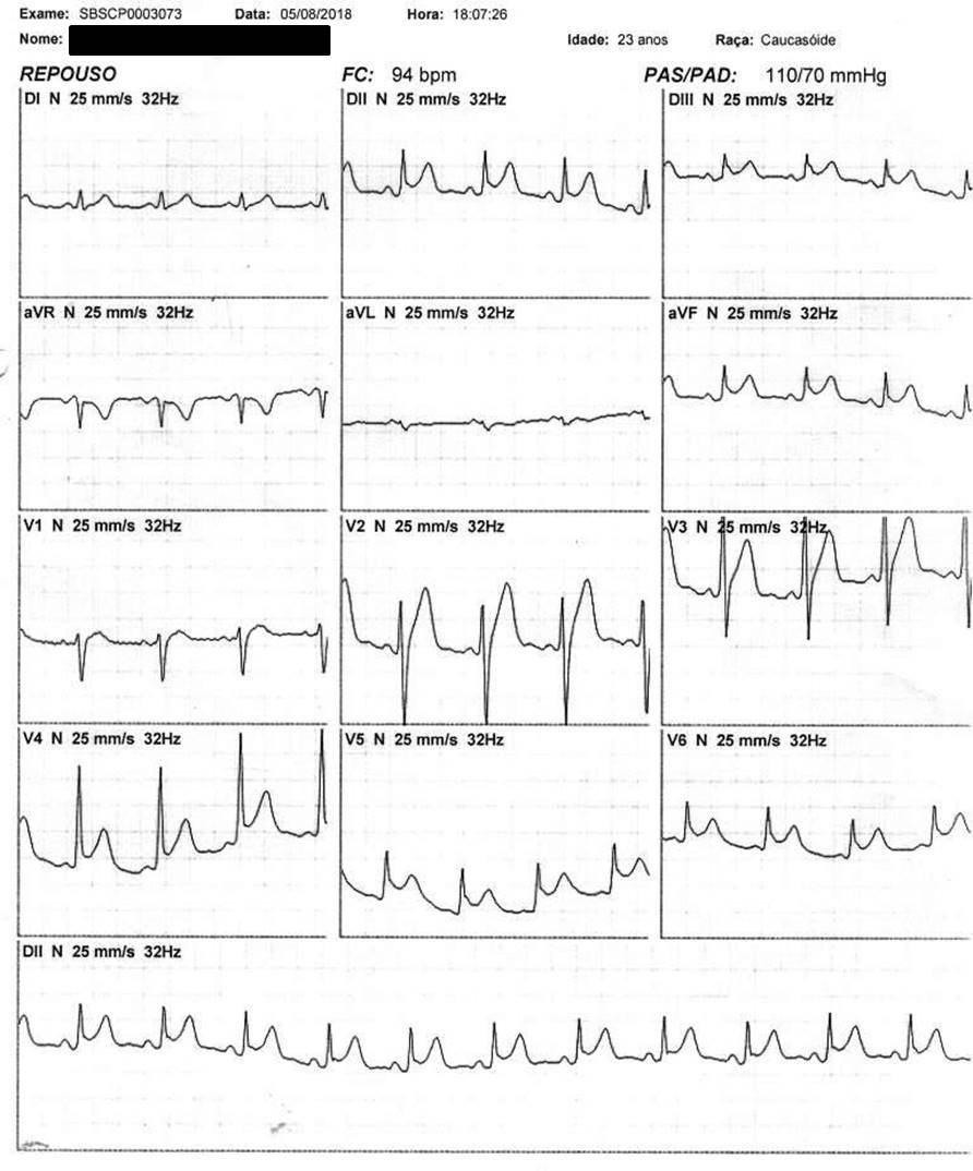 Hombre de 24 años que cursa con dolor precordial y diarrea, sin fiebre, en el que se constata pericarditis aguda