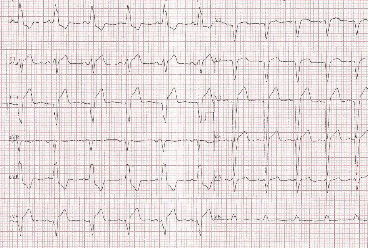 Hombre de 52 años que presenta IAM de cara inferior asociado a BCRI por oclusión de la arteria ventricular posterior rama de la CD
