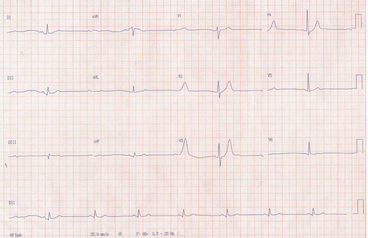 Paciente masculino de 64 años que cursa IAMCEST por compromiso de la arteria margimal de la Cx