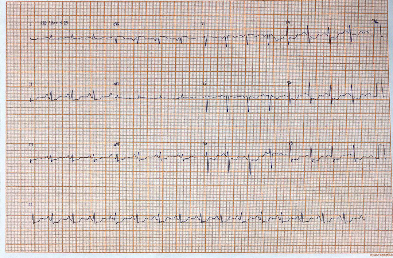 Paciente masculino con antecedente de cirugía de revascularización previa que presenta angor prolongado por compromiso de TCI y Cx