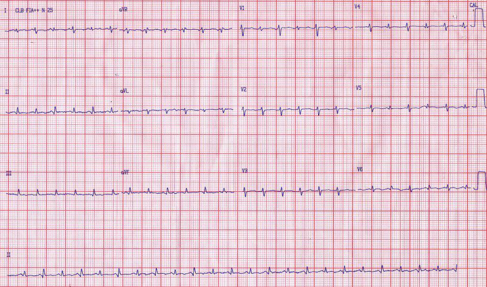 Paciente varón de 31 años VIH reactivo con dolor precordial y disnea que presenta taponamiento cardíaco