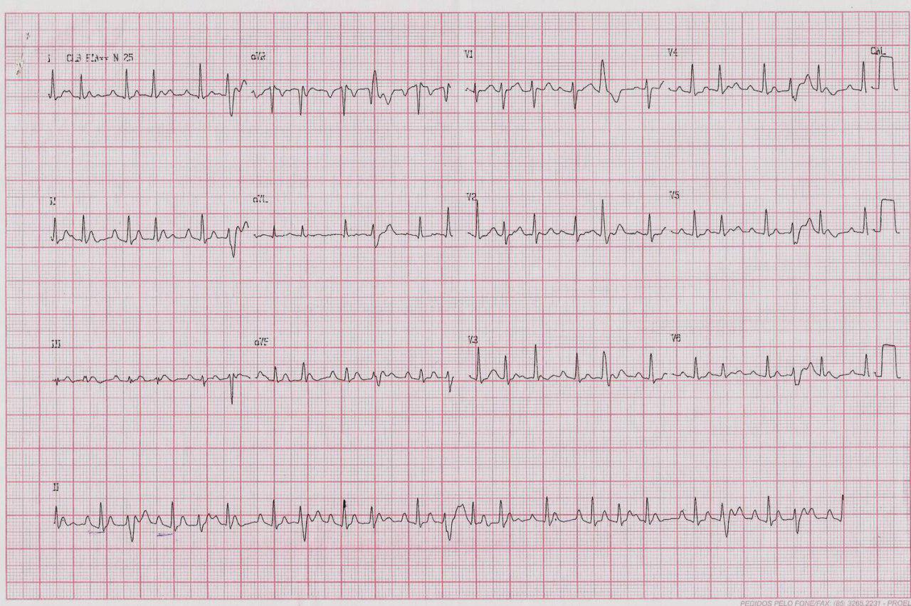 Mujer de 39 años con palpitaciones por presentar taquicardia auricular automática con grados variables de BAV y aberrancia en fase 3 de ciertos latidos, que cede con metropolol EV