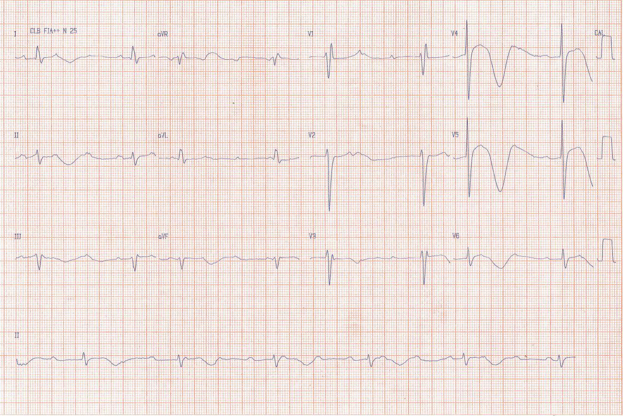 Anciana con convulsiones tratada con anticonvulsivantes que mejora con implante de MP por presencia de BAVC