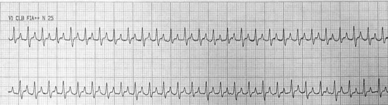 Hombre joven con palpitaciones por presentar TRAVO que termina con una onda P por presencia de Wolff Parkinson White